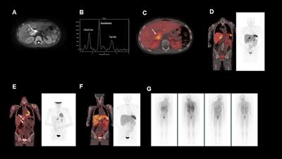 The use of temozolomide in paediatric metastatic phaeochromocytoma/paraganglioma: A case report and literature review